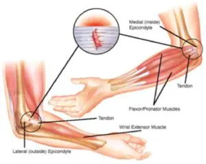 golfers-elbow
