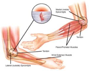 golfers-elbow