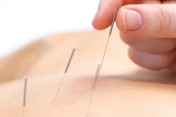 Dry Needling