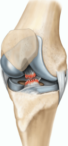 acl injury hoppers physiotherapy treatment