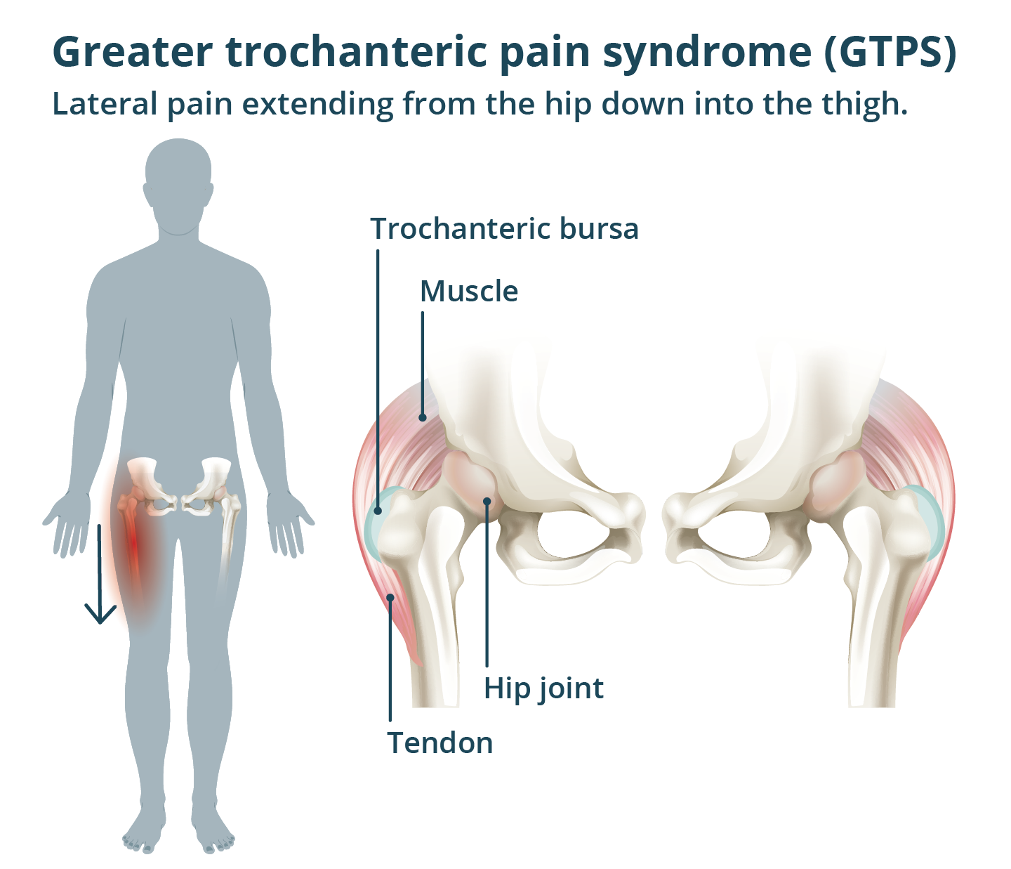 Greater Trochanteric Pain Syndrome GTPS